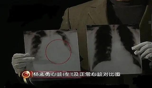 🌞2000年，哈尔滨一20岁小伙车祸离世，他的心脏被移植给了一位57岁大叔