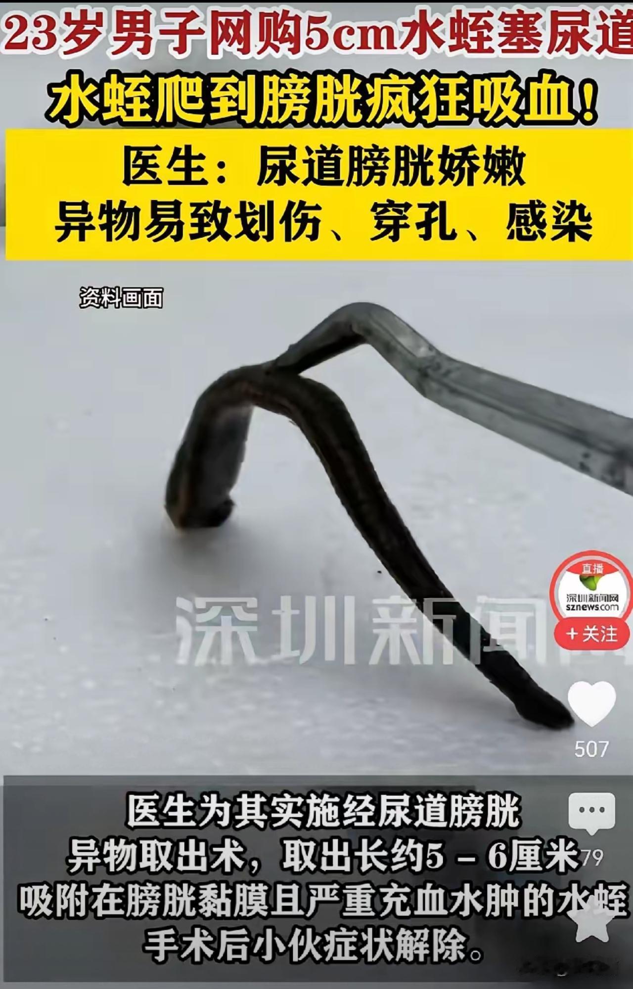 离谱到窒息！23岁小伙把5cm活水蛭塞进尿道，网友：这是拿命猎奇？真的被河