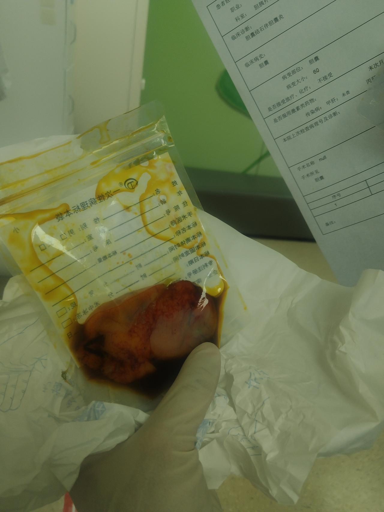 实在搞不懂现在是医学进步了还是过度治疗了？胆结石切胆囊，阑尾炎切阑尾，讲起来还是
