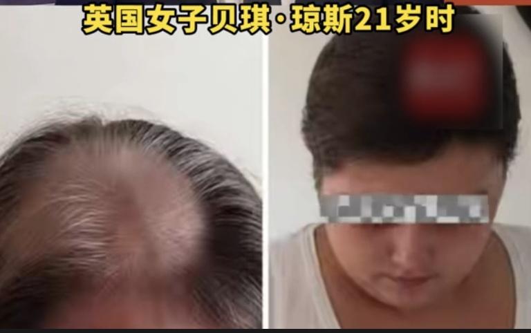 “作孽！”一女子21岁时，被确诊脑癌晚期。她坚持化疗11年后，竟得知自己压根没患
