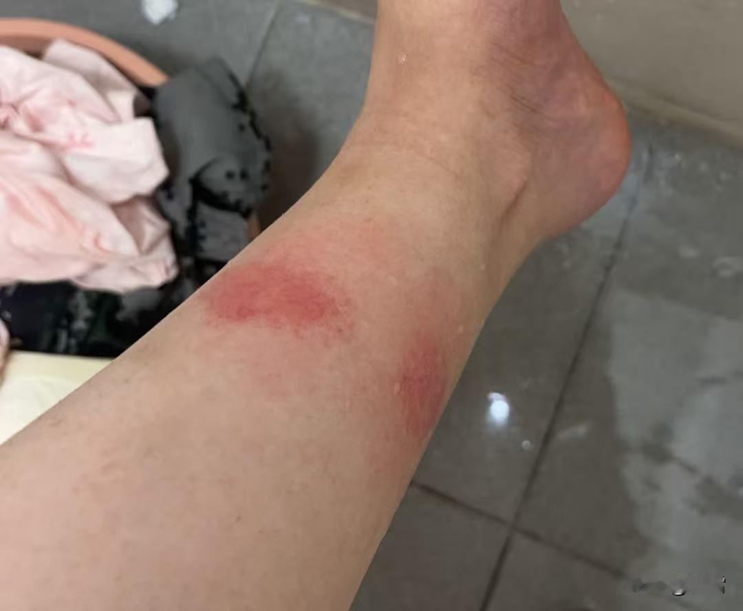 大一新生，军训第2天就被红蚂蚁咬了两个大包！小孩的大学就在广州的小谷围岛上，据