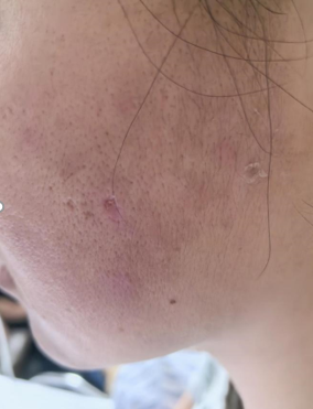 女子挤痘痘挤出“坑”引发败血症 面部这个危险三角区别乱碰