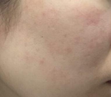 脸上长痘怎么办? 祛痘调理如何做?