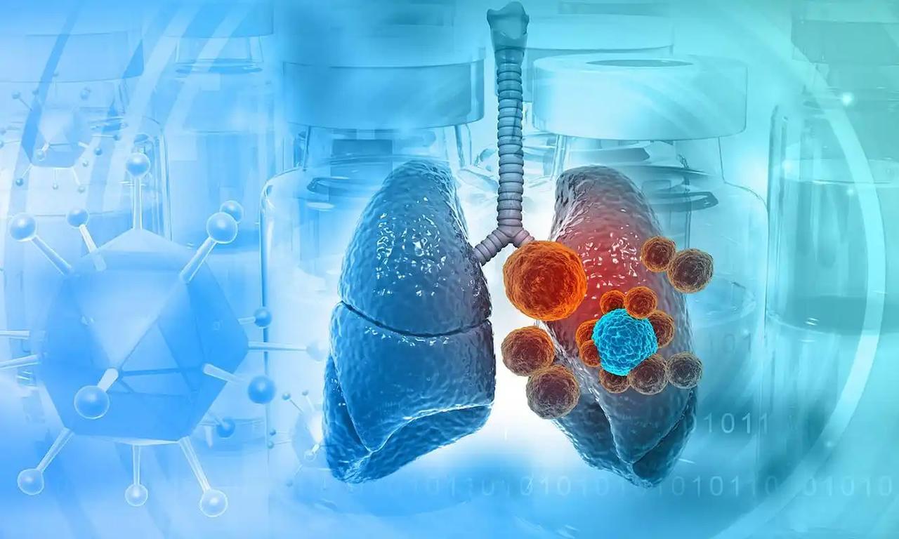 复旦大学解剖470名肺癌患者,惊奇发现:患肺癌的人,有5大共性58岁