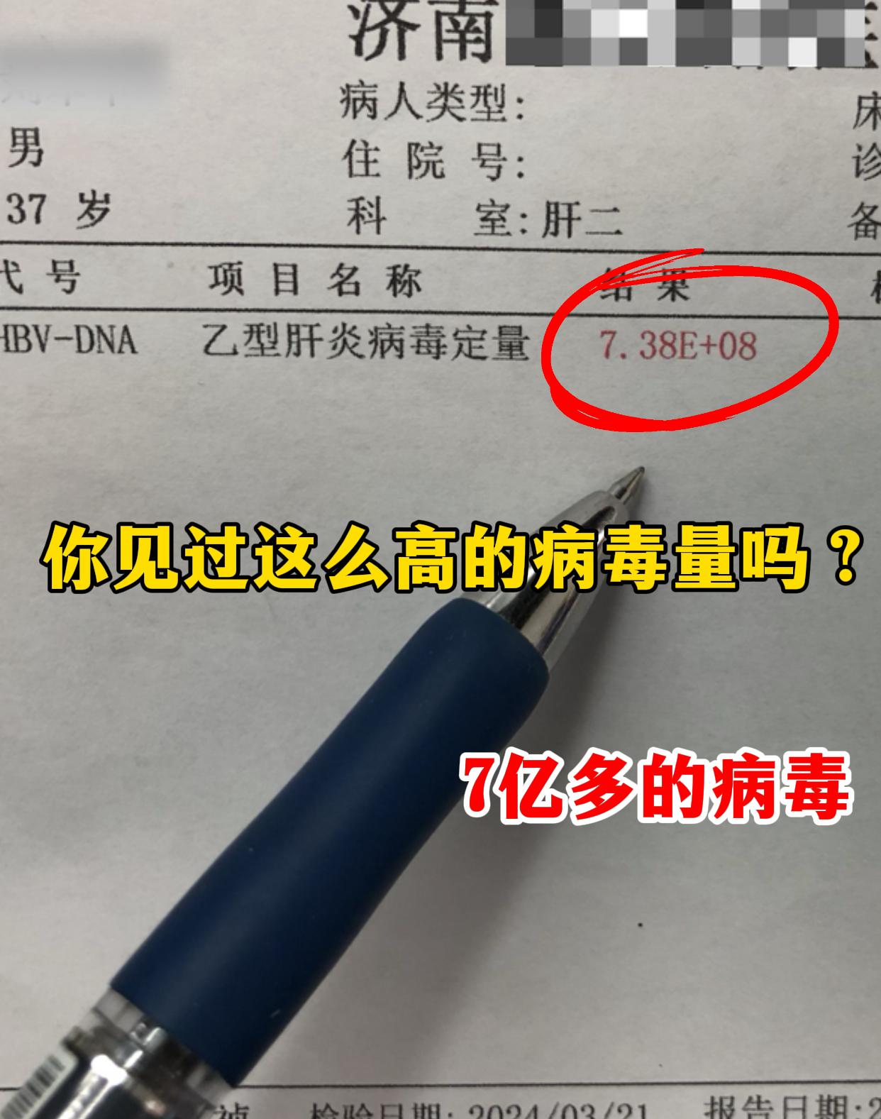 今天门诊碰到个山东本地的乙肝大三阳患者，说最近总觉得没劲儿、吃啥都恶心...