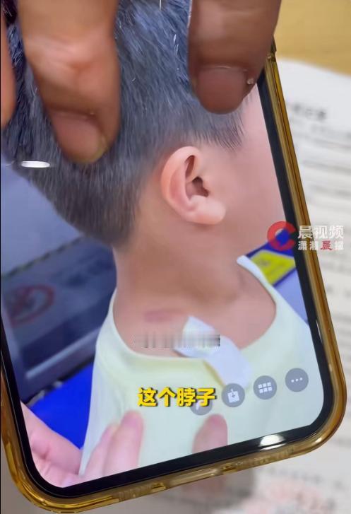 “爸爸，我是不是做错事了？”4岁男孩跑步不小心碰了女子臀部，被揪着衣领勒出淤青。