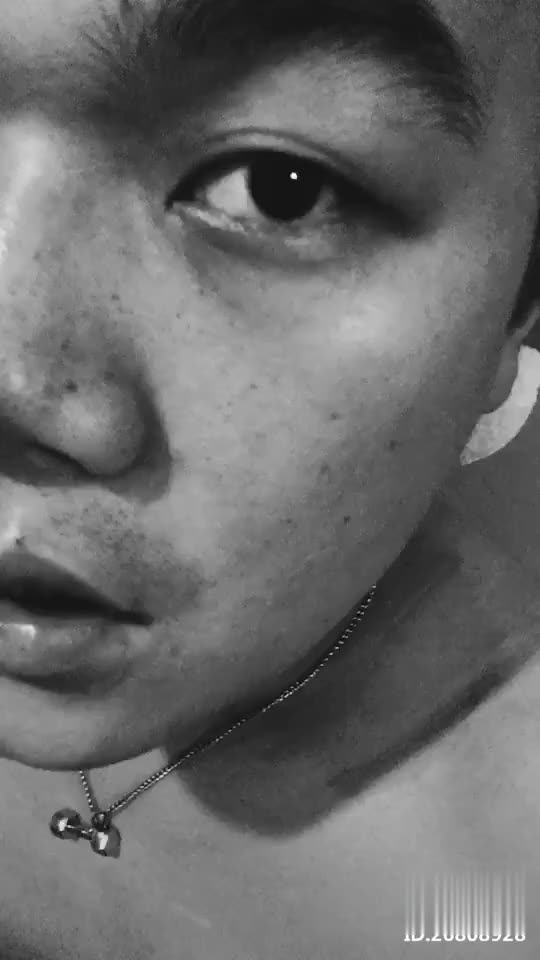 (182)张孟超医师-腹诊(小腹轻度压压痛+全腹鼓