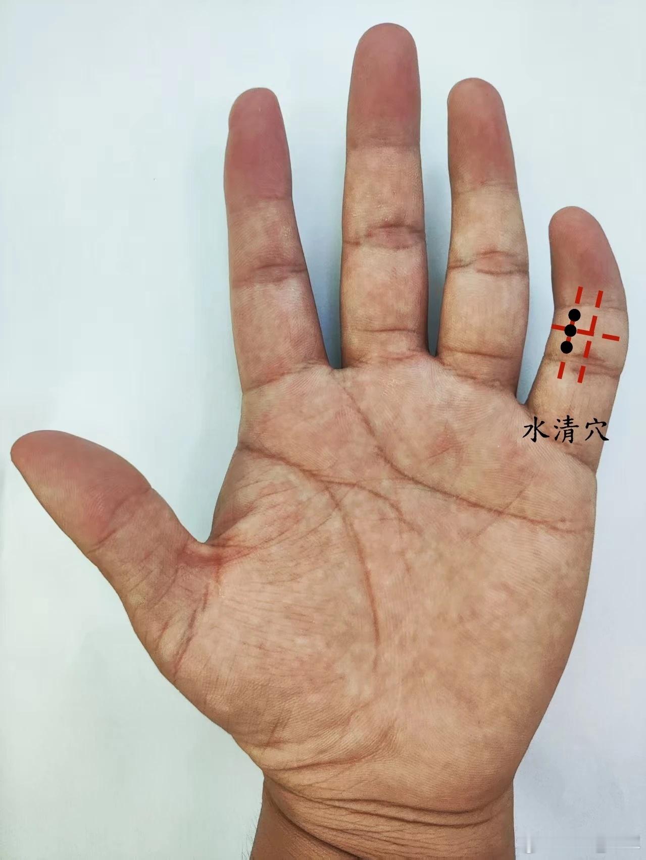 膀胱炎、尿道炎，水清穴水清穴源自董氏奇穴位置：在手掌面，小指第二节中央线偏桡侧