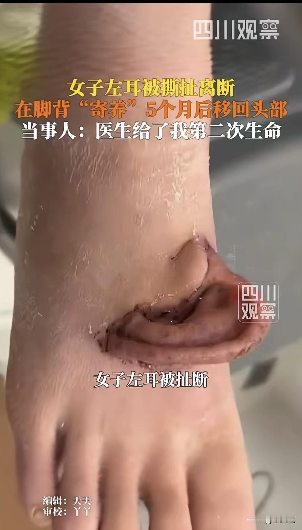 天下之大无奇不有！山东一女子因为意外，导致左耳断裂，送医后，医生竟然将耳朵“寄养