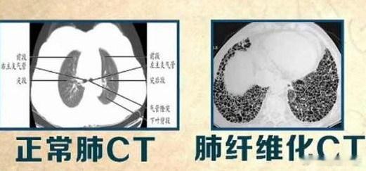 为什么说“肺纤维化”，是一种特殊病？因为，肺纤维化确诊后的平均生存期大概三年左右