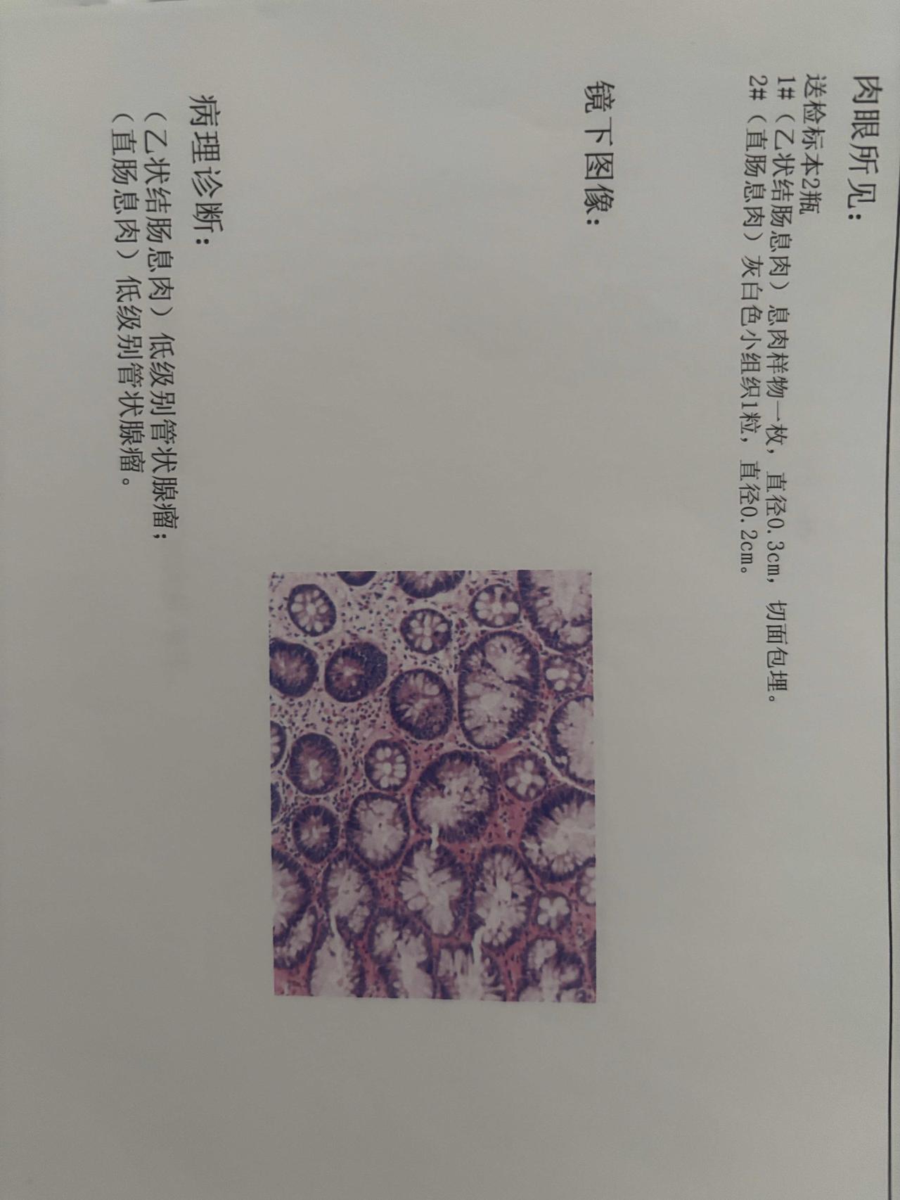 我的胃肠镜检查结果出来了，总结一下：实际花费大约二百多。两个肠道息肉都是