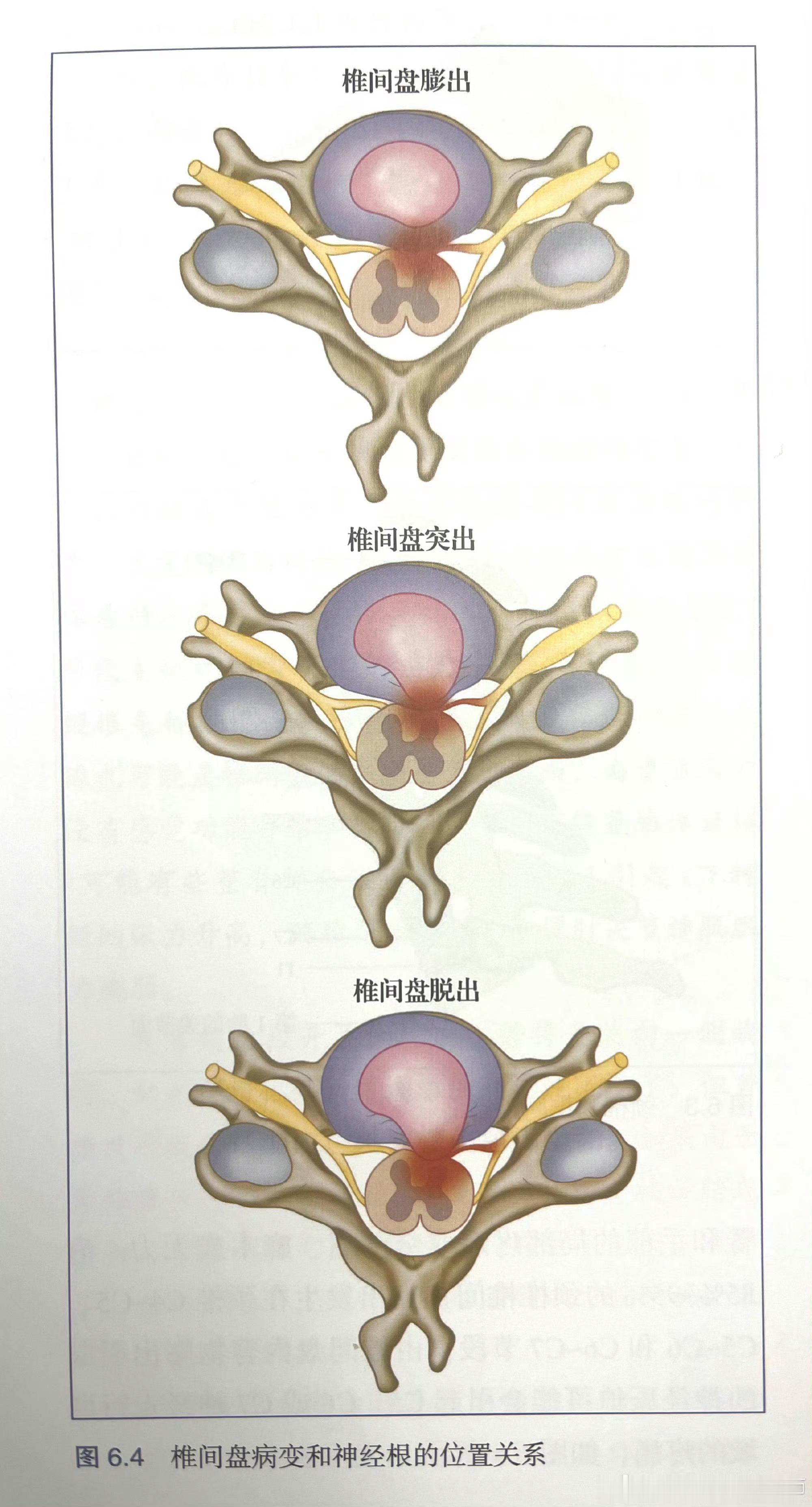 什么是腰突一张图带你了解——腰椎间盘膨出-突出-脱出之间的区别与关系