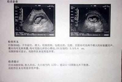 顺产双胞胎男宝, 分享孕期男宝特征, 体会深刻