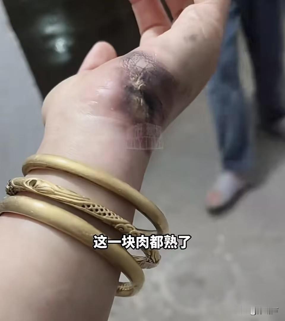 这被电的有点狠，肉都被烫熟了，估计当时也被吓到了吧。10月25日安徽宿州的刘女子