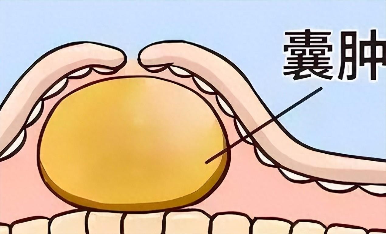 结节、息肉、囊肿总复发？别盲目开刀！3个中成药，从根散结、防复发提示：本内容