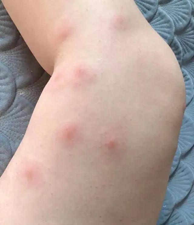 一群人中，蚊子为何只咬你？其实与血型无关，真正的缘由有4个很多人以为蚊子