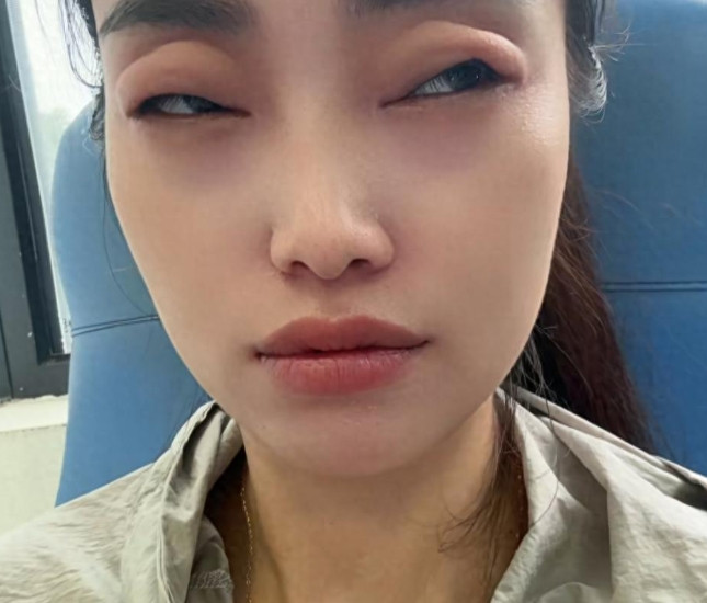 杨梅正当时！女子吃两颗眼睛险失明，有人吃到进急救室