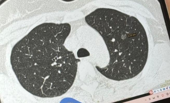 体检查出肺结节，到底多大才要做手术？我的临床原则讲给您听......最近碰到很多