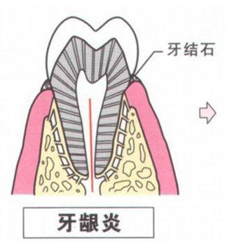 有了牙龈炎如何治疗? 其实很简单