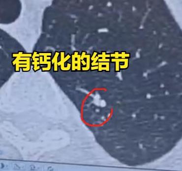 看到CT报告上写着“肺结节伴钙化”，很多人心里都会“咯噔”一下，立马联想到肿瘤？