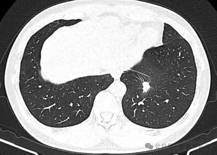 查出肺结节或肿块，怎样看是不是肺癌？医生讲4个恶性表现肺上发现一个结节，医生