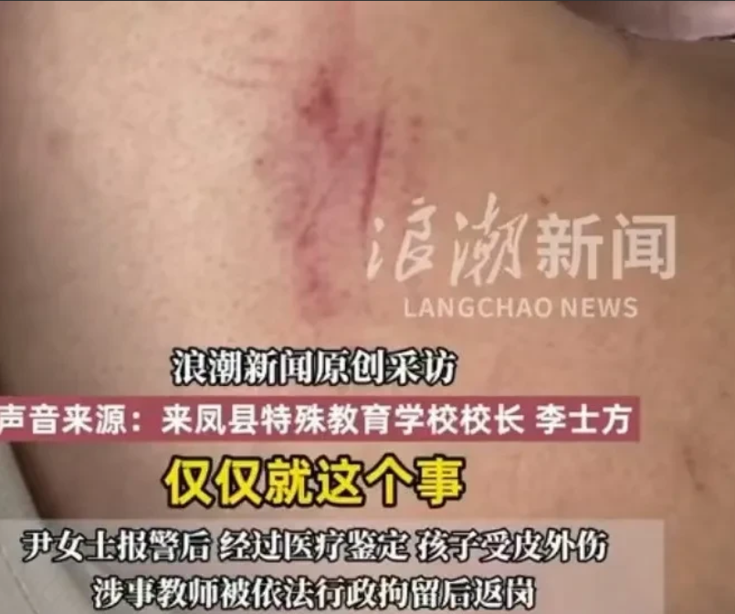 湖北恩施，女子将17岁的自闭症儿子，送往特殊学校，结果儿子被打伤，她说，她的儿子
