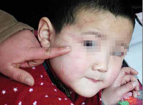 宝宝脸肿, 幼儿园老师说: 小朋友打的! 发现真相, 家长炸开锅