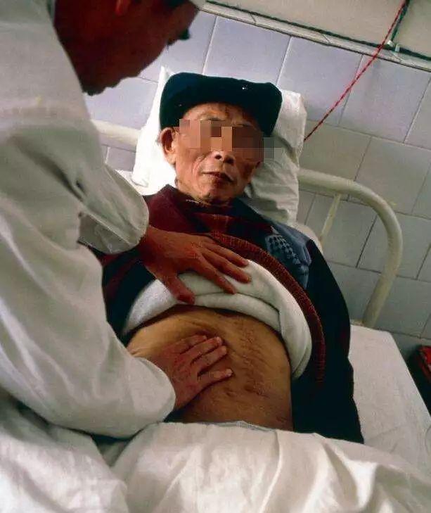 身体发出这5个信号, 暗示你的肝已经硬化了! 发现一个赶快就医