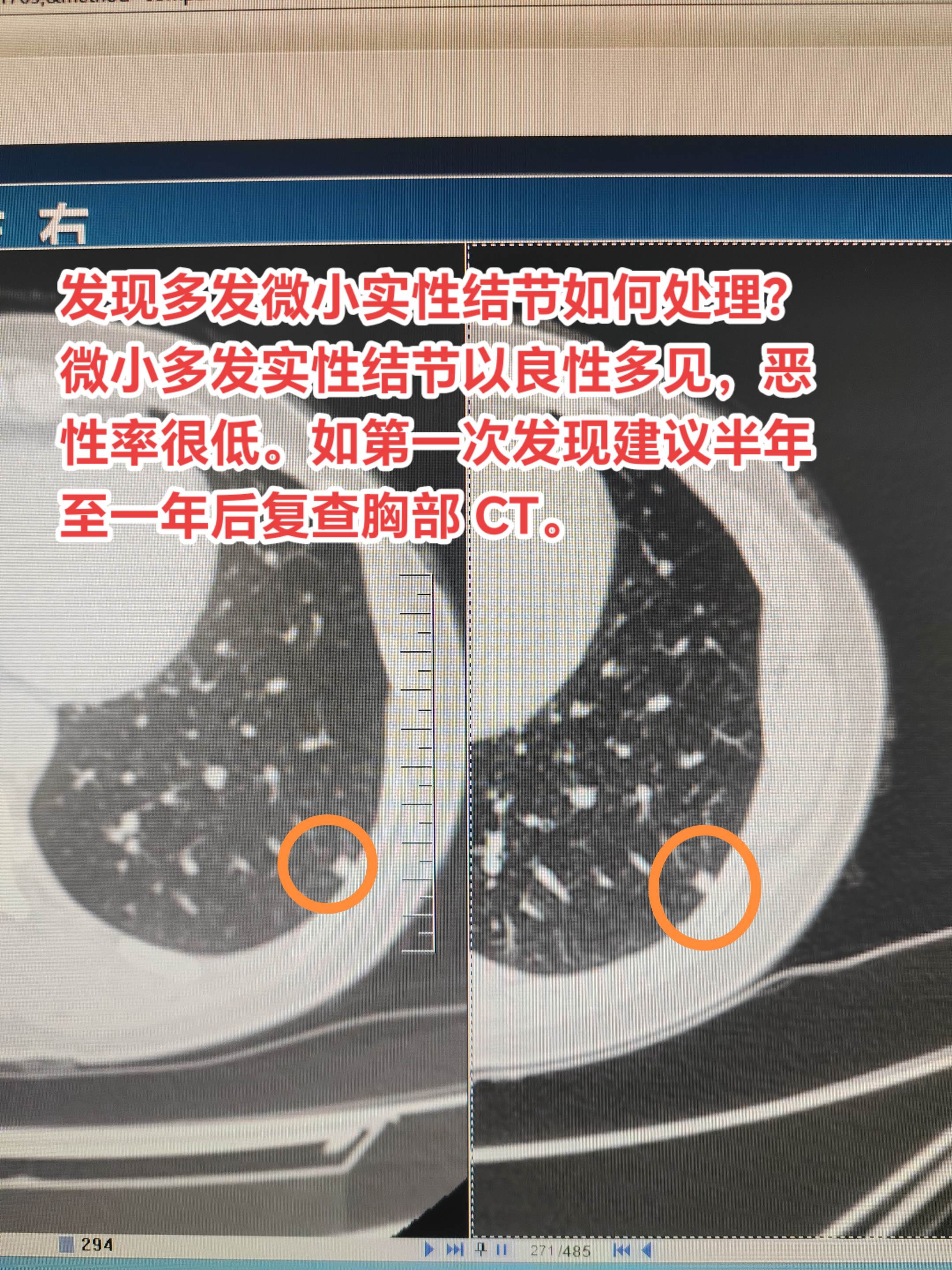 发现多发微小实性结节如何处理？微小多发实性结节以良性多见，恶性率很低。...