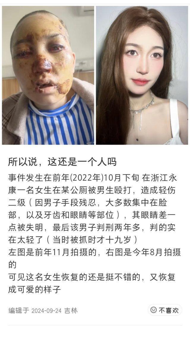 【转发扩散！浙江公厕被打女孩确诊白血病，急需骨髓移植手术费】曾牵动无数网友的“浙