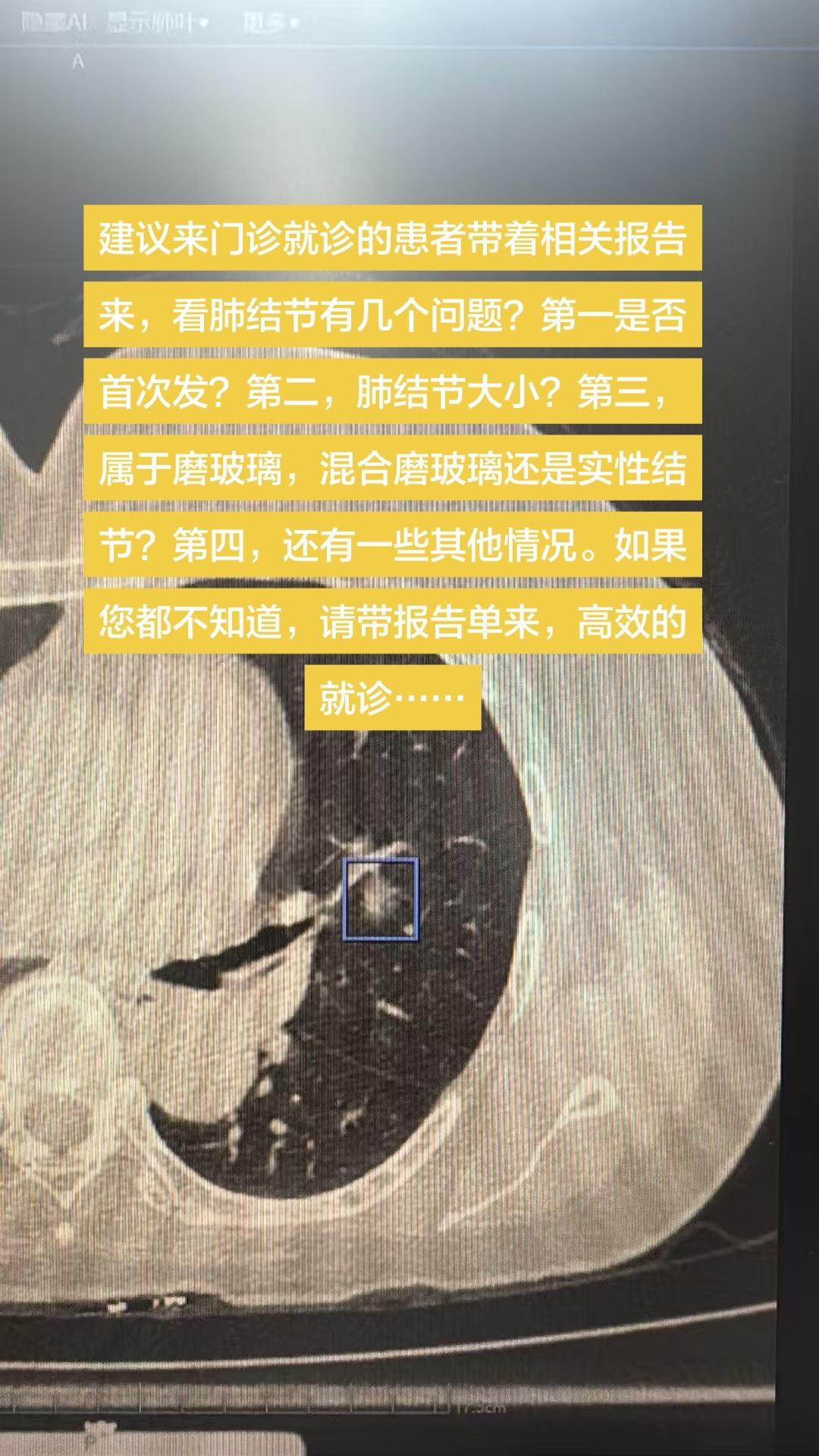 如何高效的看肺结节门诊。建议来门诊就诊的患者带着相关报告来，看肺结节有...