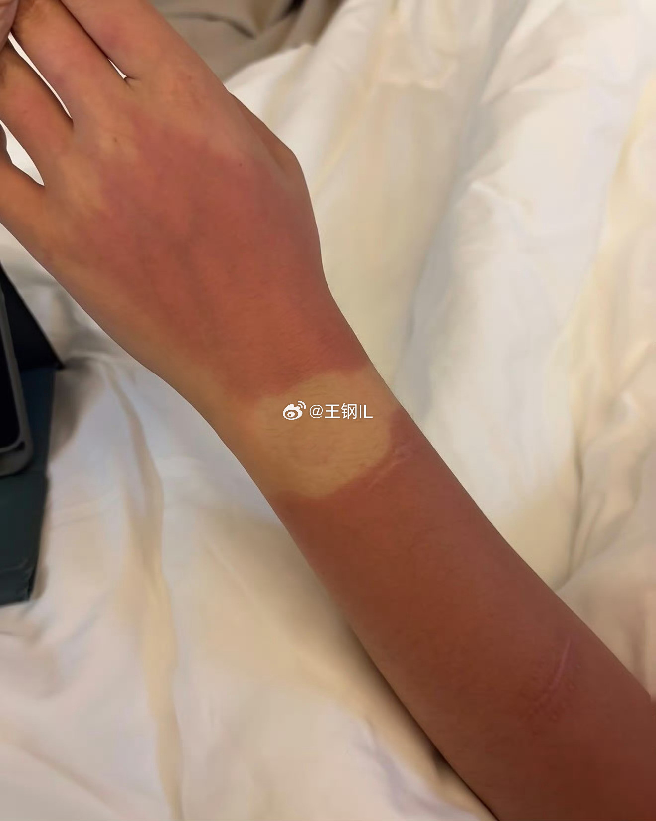 云南的紫外线我给到夯前些天执行项目，去了一次云南。紫外线确实给我上了一课，晒得我