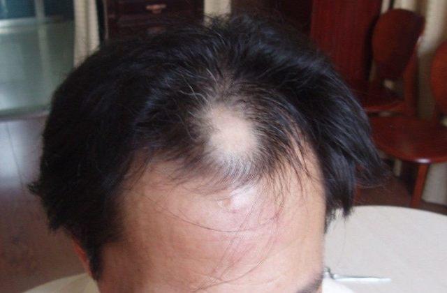如果你的身体没出现这5个症状, 恭喜: 你的肾脏非常健康!