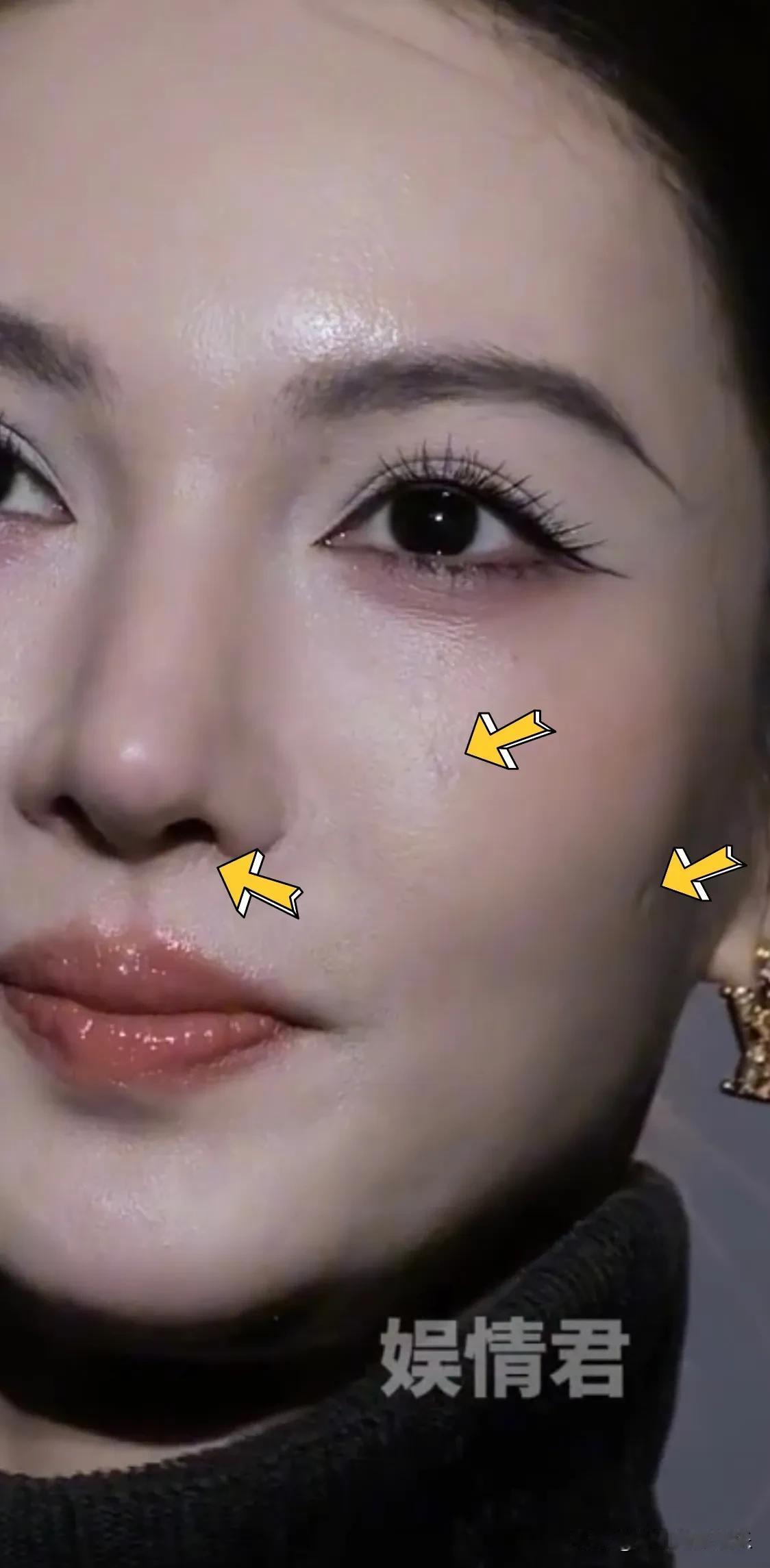 金晨脸上都是微整留下的疤痕，她完全不承认动脸，说是自己化妆技术不行。金晨鼻子