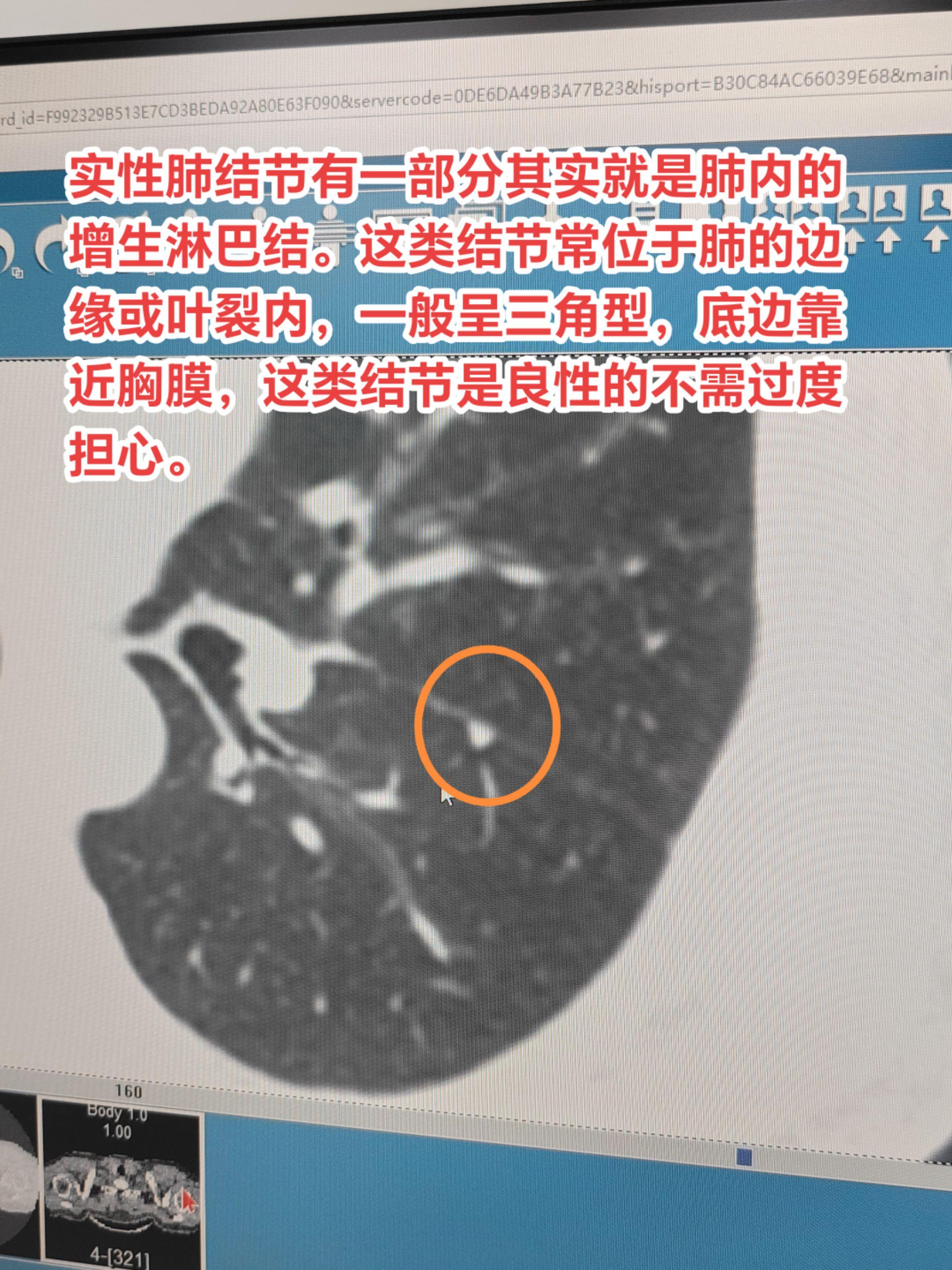 什么样的肺结节考虑良性？实性肺结节有一部分其实就是肺内的增生淋巴结。这...