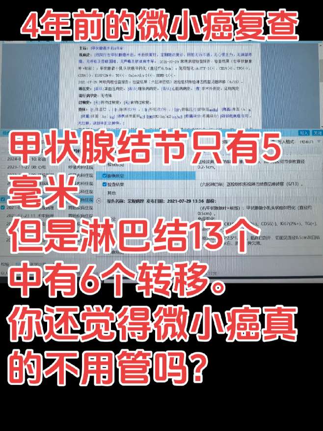 微小癌，要重视。再小的甲状腺癌，都不可以忽视哦 有些时候，没手术之前...