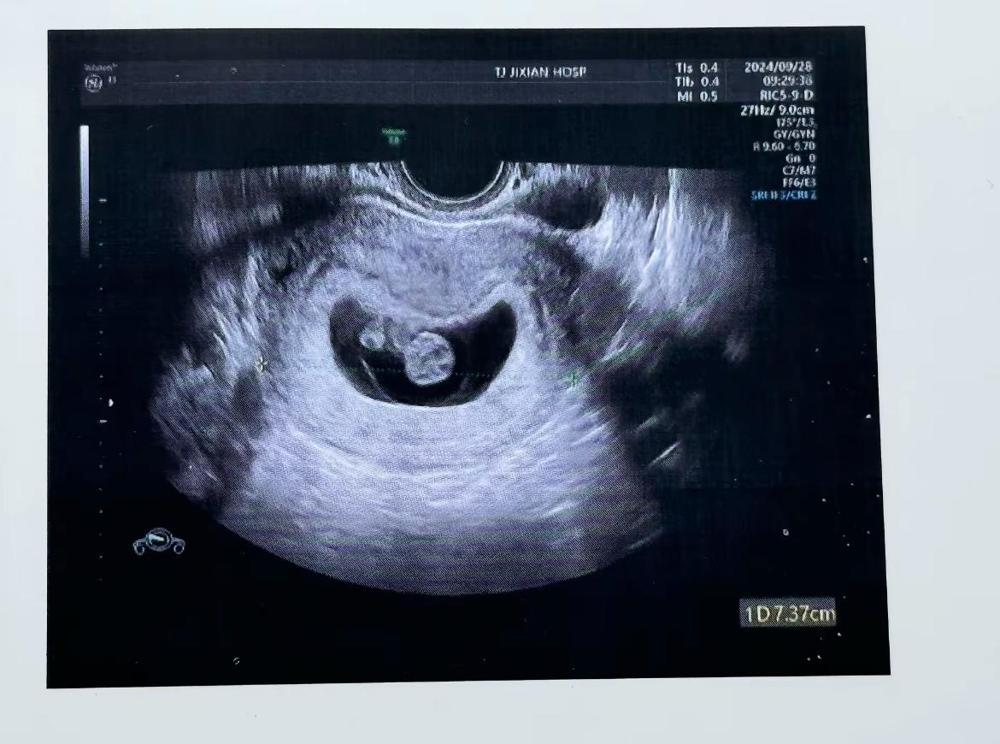 心酸，我生了3个女儿，现在又怀孕5个多月了。昨天去做四维，大夫问我前几胎是男孩女