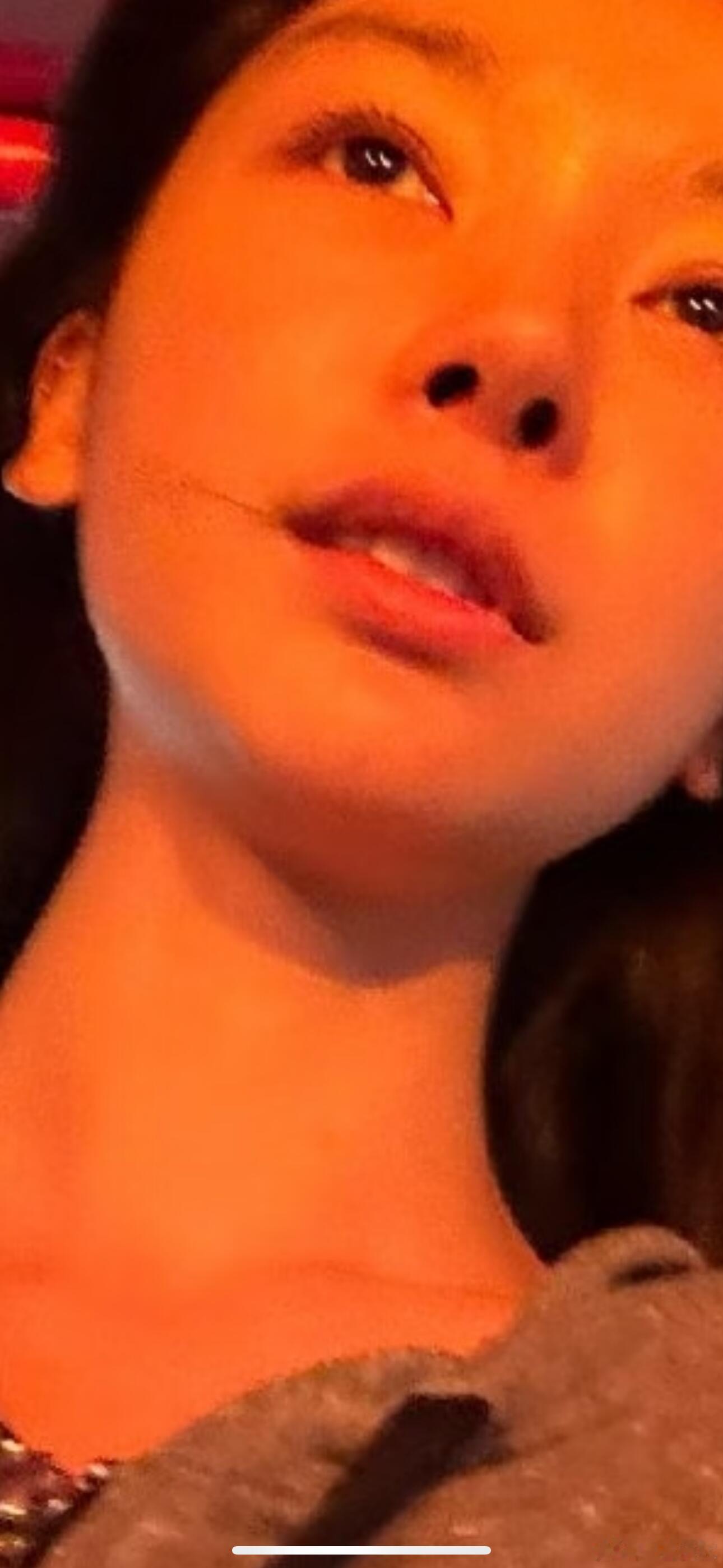 易梦玲这个缩鼻翼垫鼻尖还挺明显的