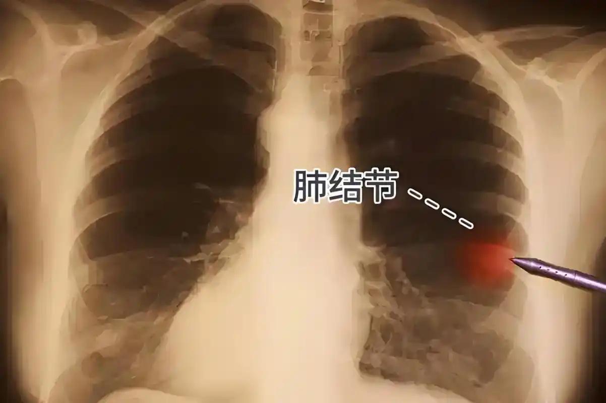 我国有上千万人做肺CT！医生坦言：查一次肺CT，或管数年无碍大家好，我是陈
