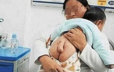 男婴出生屁股后面竟长出“尾巴”, 都怪妈妈忘记做这件事