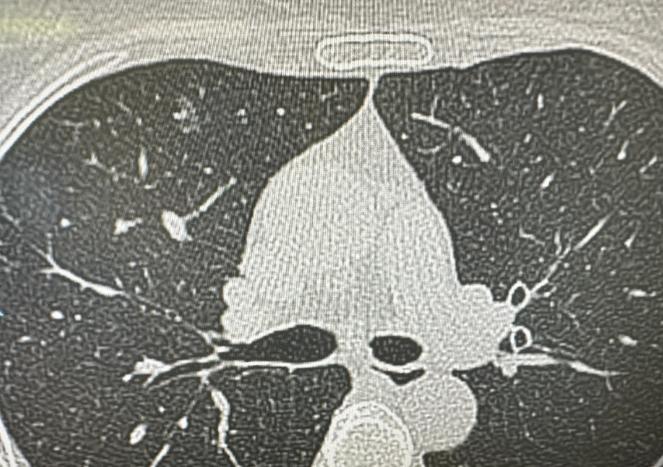 肺结节切了又长，什么时候才能结束？这是一位55岁患者的真实经历。三年前，她因为右