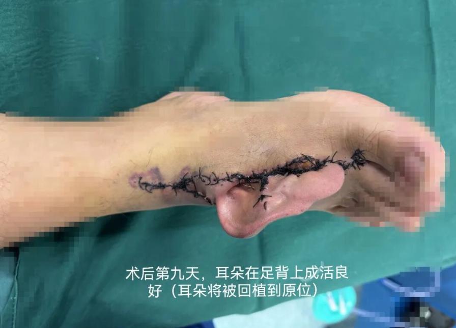 上海九院王庭亮团队为一名右耳完全离断、创面血管闭合的患者，实施全球罕见的“异位寄