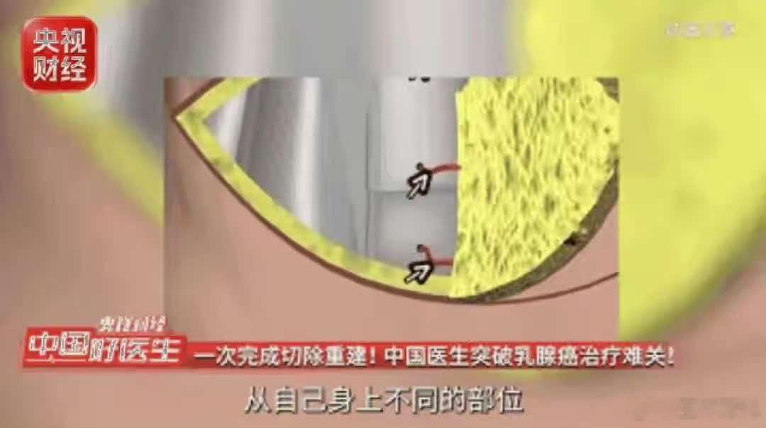 乳腺癌一定要全切吗乳腺癌一定要全切吗？切得越多，是不是越安全？这是许多患者甚至是