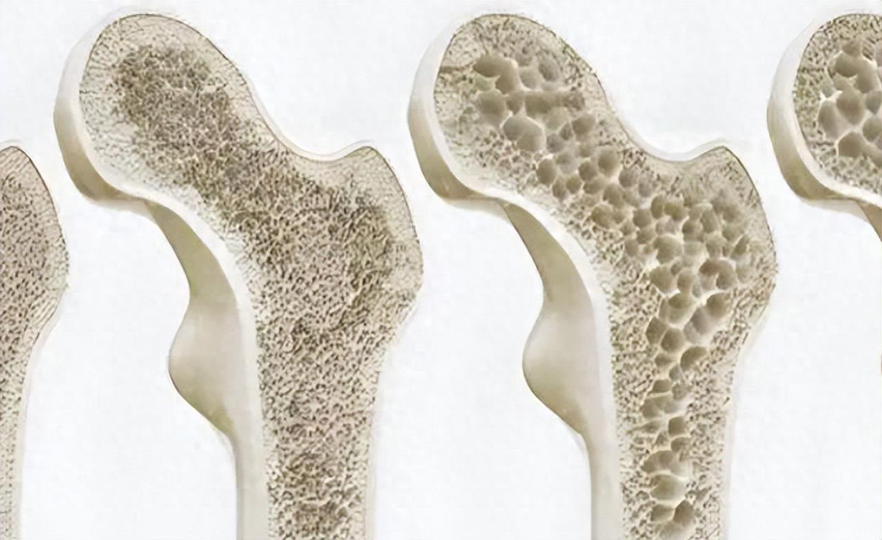 54岁阿姨的骨密度如同30岁，主任问她原因，她坦言做对了这三件事骨密度这个指