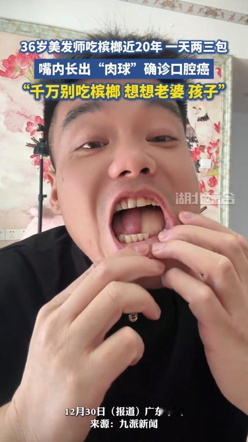 “还敢吃槟榔吗？”广东中山，一男子嚼槟榔近20年，两年前牙齿变得松动，口腔也频繁