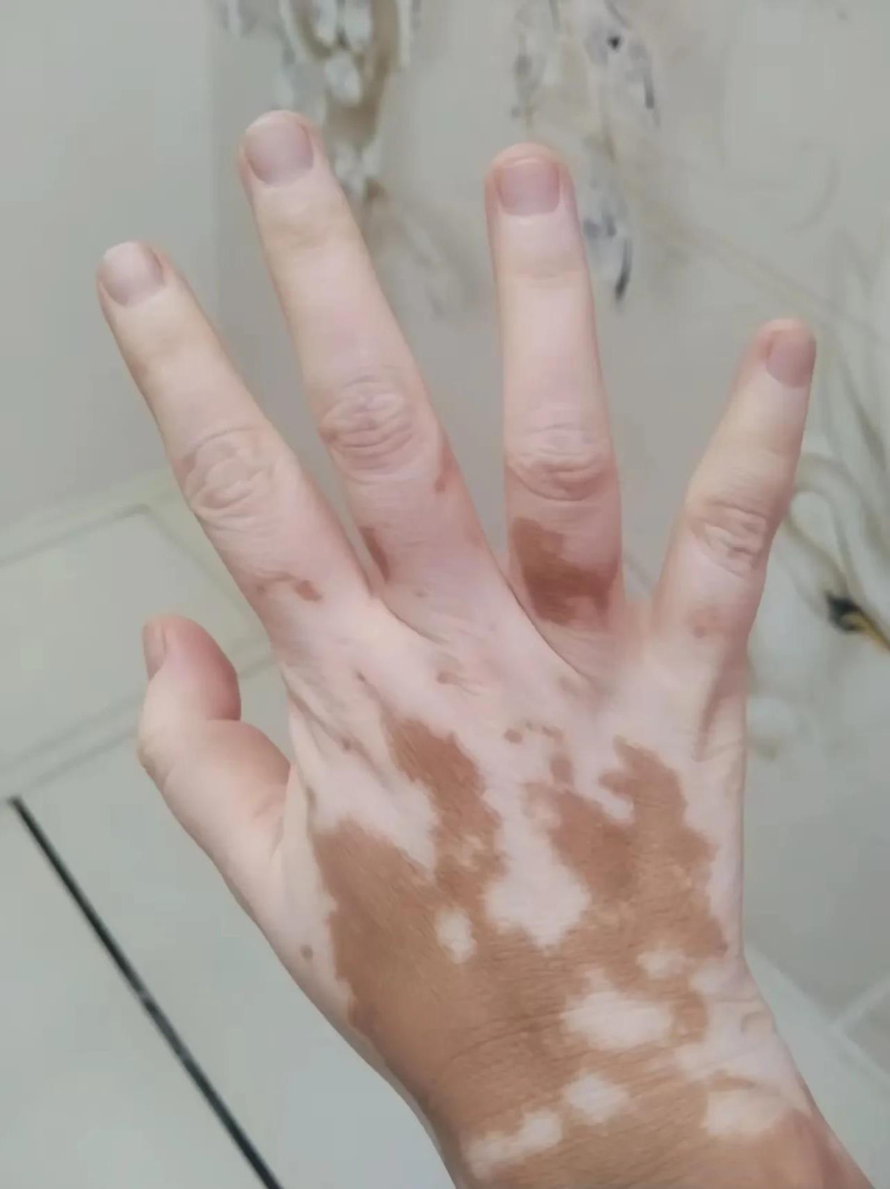 朋友得了白癜风，为此娶不了媳妇儿，这病传染吗，能治好吗？有人说，白癜风治不好。