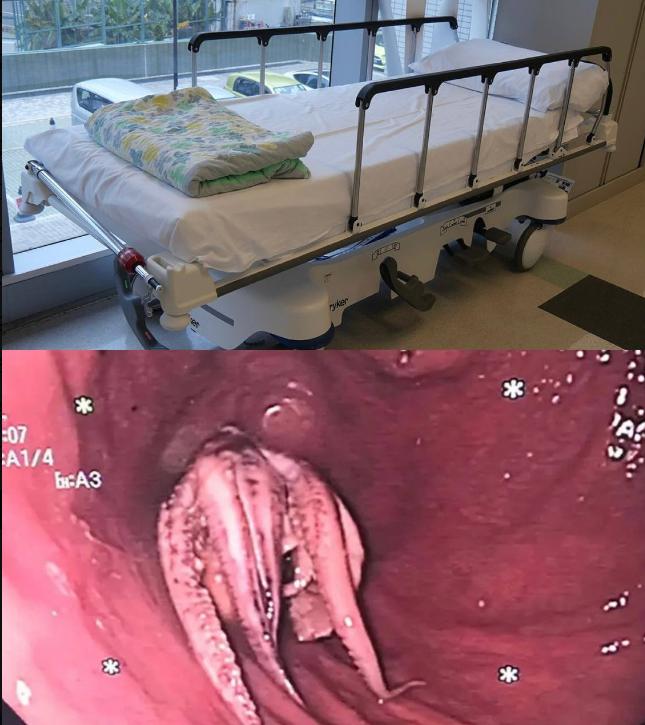 一名男子因感觉喉咙有异物卡住而前往医院就诊。医生发现他的食道内卡着一整只章鱼。