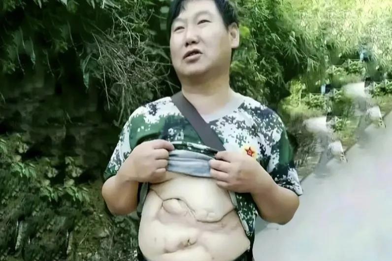 照片中这名全身伤痕累累，历经九死一生活了下来的人，就是老山一等功臣、甲级伤残军人