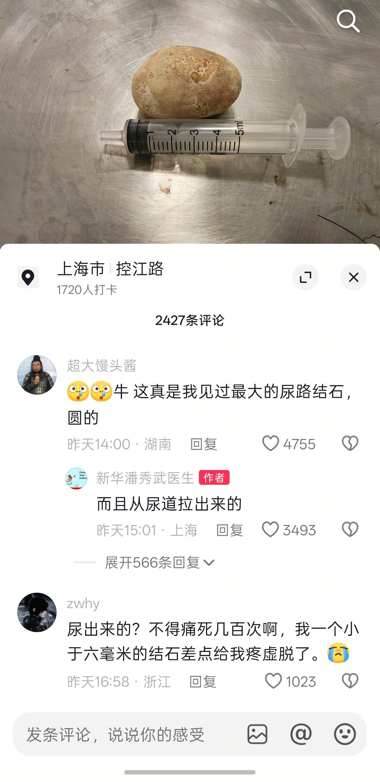你是说，这颗土豆一样大的结石，是从尿道里取出来的？嘶……​​​