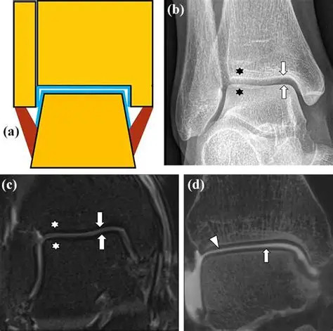 一句话康复科普如何诊断距骨软骨损伤？01.临床检查：通过触诊和步态观察初步判